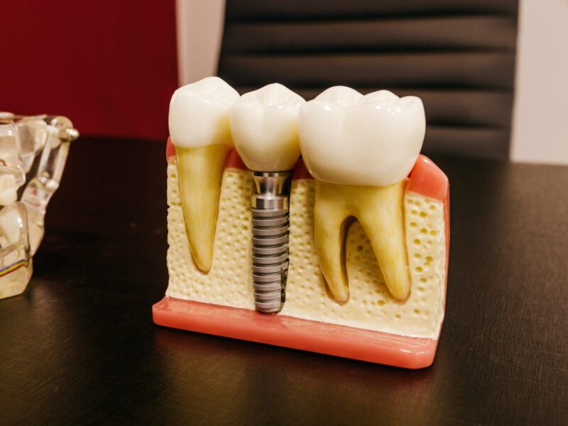 dental implant model on table
