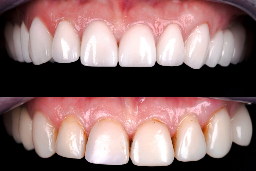 composite bonding before and after